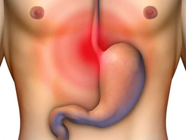 Διάτρηση στομάχου: Ποια είναι τα συμπτώματα, οι αίτια, οι επιπλοκές και πως την αντιμετωπίζουμε-Βίντεο